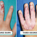 The Ultimate Guide to 2nd Degree Burn Healing Stages