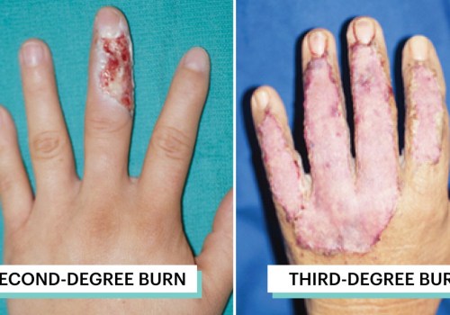 The Ultimate Guide to 2nd Degree Burn Healing Stages